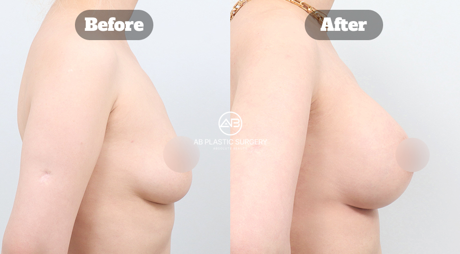 Profile View Before and After Mentor Breast Implant Surgery for Sagging Breasts Showing Increased Volume and Projection