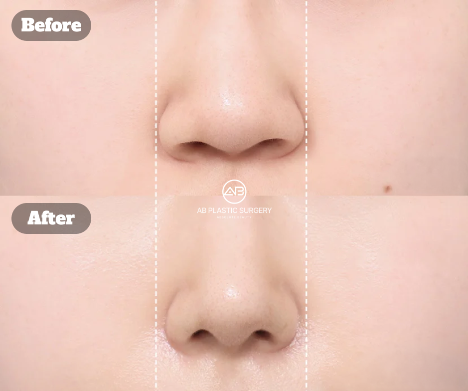 Before-and-after comparison showing changes in nostril width one month after alar base reduction surgery.