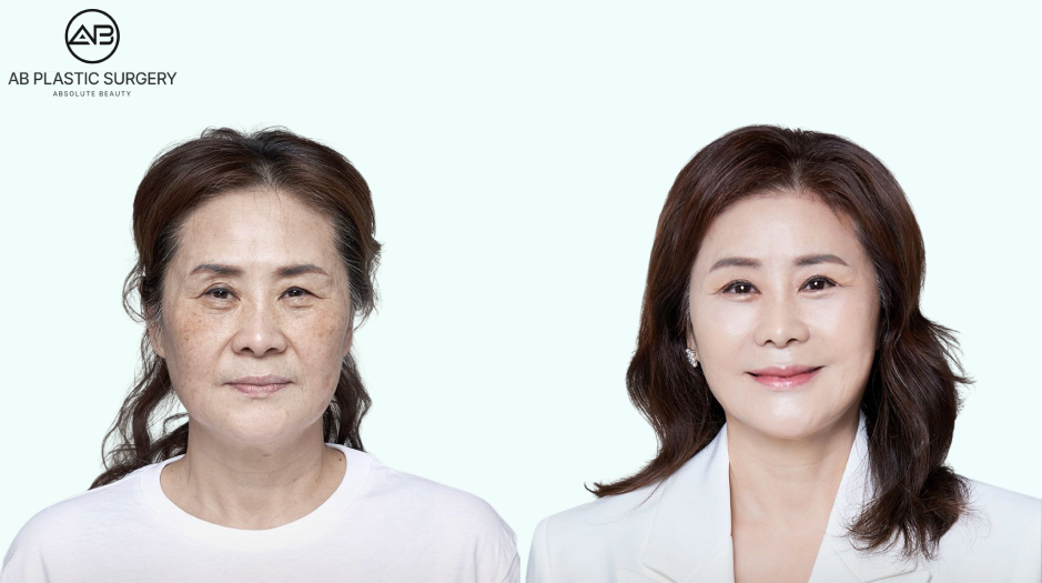 AB Plastic Surgery Korea before-and-after image of an older woman following upper blepharoplasty for droopy eyelids