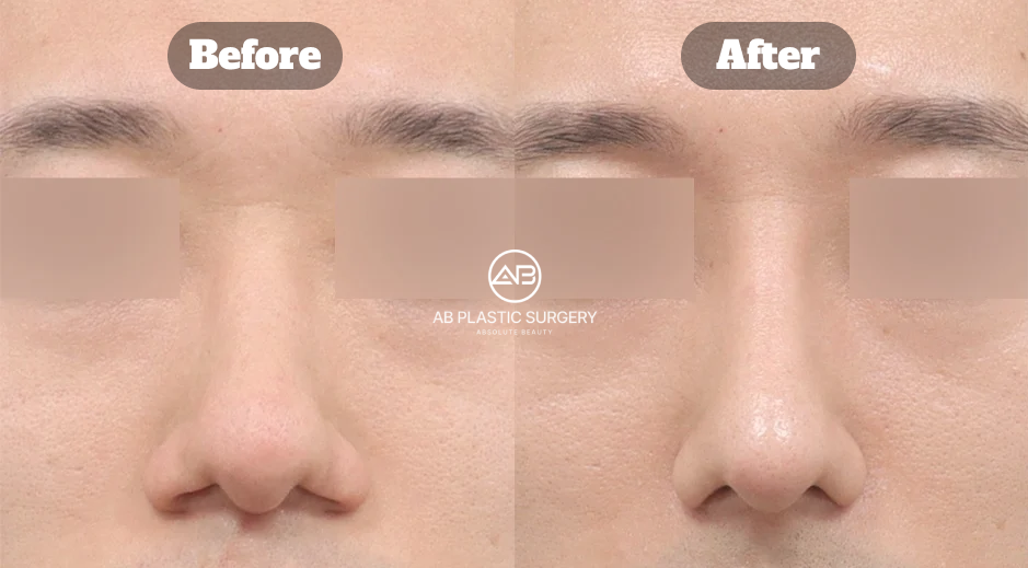 Before-and-after comparison of a male patient following bulbous nose rhinoplasty and alar base reduction.