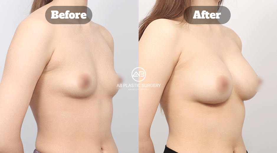 Side View Before and After Mentor Breast Augmentation Showing Increased Breast Volume and Projection