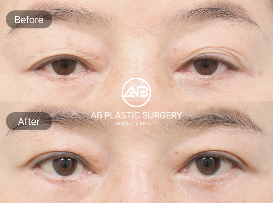 AB Plastic Surgery Korea close-up showing reduced upper eyelid hooding after upper blepharoplasty