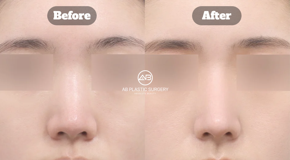Before-and-after comparison following bulbous nose rhinoplasty, nasal osteotomy, autologous rib cartilage grafting, and alar reduction.