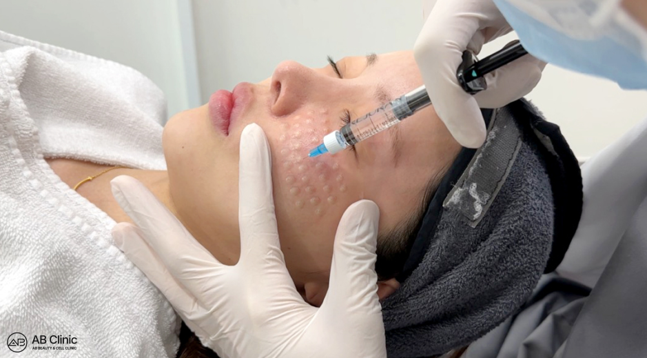 Clinician performing facial microinjections with temporary raised injection points visible on the skin