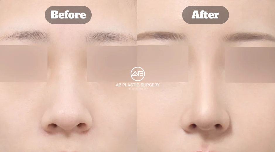 Before-and-after comparison following revision rhinoplasty for a dorsal hump with additional alar base reduction.