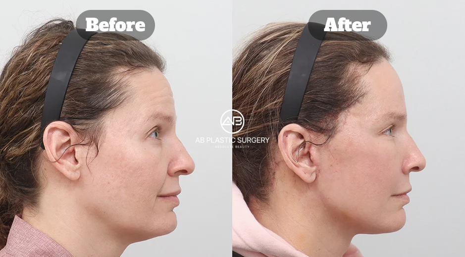 Side-profile before-and-after photos showing a more defined jawline and smoother lower-face contour following facial contouring treatment