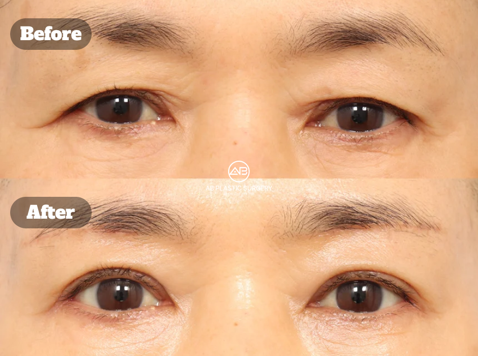 AB Plastic Surgery Korea before-and-after image of ptosis correction with upper eyelid lifting