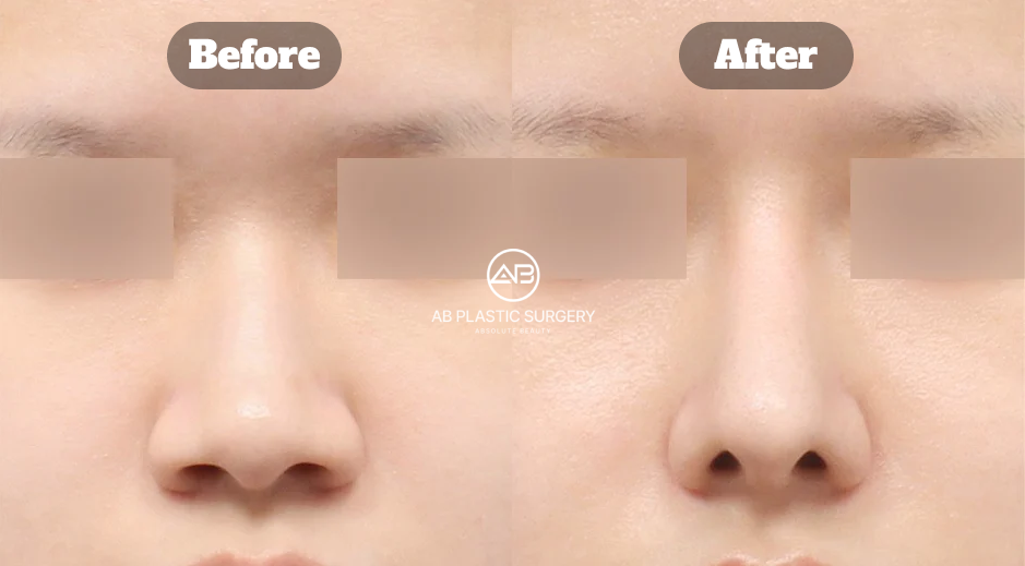 Before-and-after comparison showing the nasal contour eight months after bulbous nose rhinoplasty with autologous rib cartilage and alar reduction.