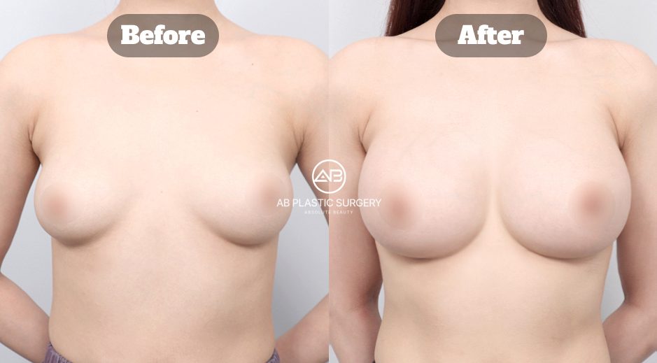 Before and After Mentor Breast Augmentation for Drooping Breasts Showing Increased Fullness and Improved Breast Position