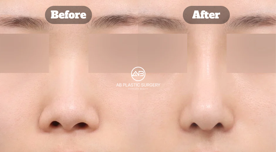 Before-and-after comparison showing changes in nasal tip and alar width one month after bulbous nose rhinoplasty and alar reduction.
