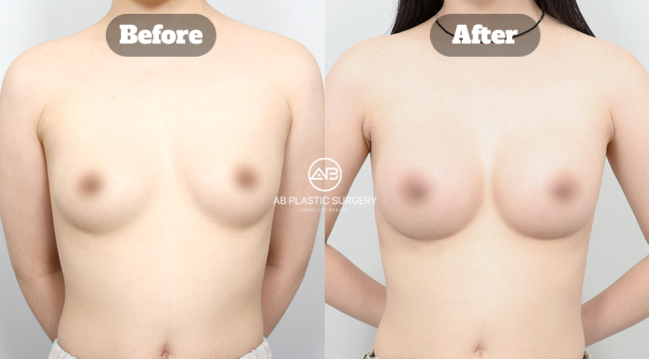 Before and After Motiva Breast Augmentation for Asymmetrical Breasts Showing Improved Volume and Symmetry