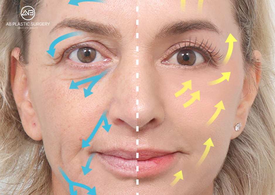 Frontal facial illustration with a dashed midline, blue arrows on the left and yellow upward arrows on the right; an educational graphic, not a clinical before-and-after result.