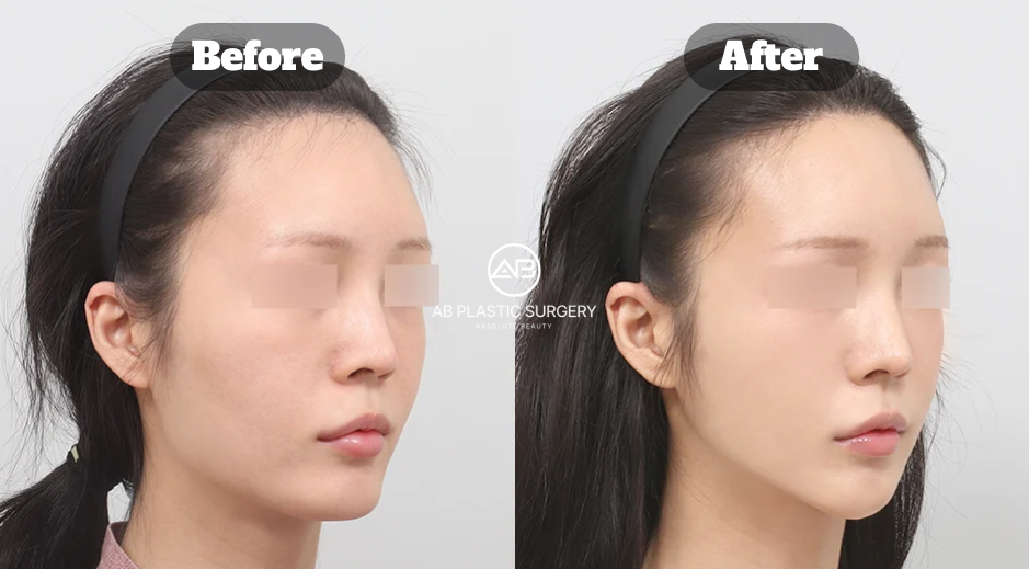 Facial contouring before and after showing changes in the cheekbone, jawline, and chin after combined facial contouring in Korea