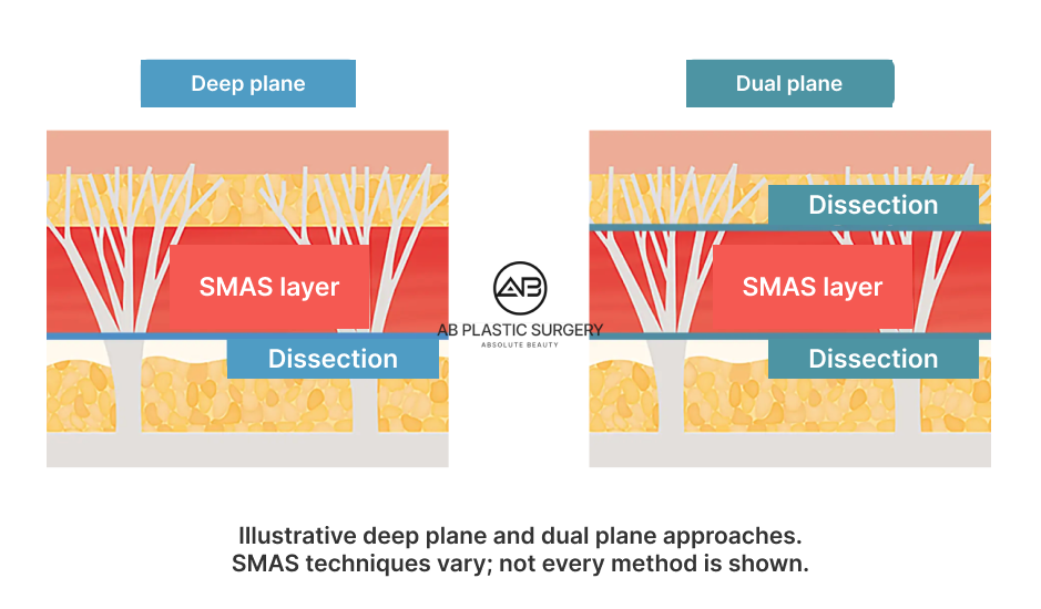 Side-by-side tissue-layer diagrams labeled Deep plane and Dual plane, with the SMAS layer and dissection planes marked; the illustration does not depict every SMAS technique.