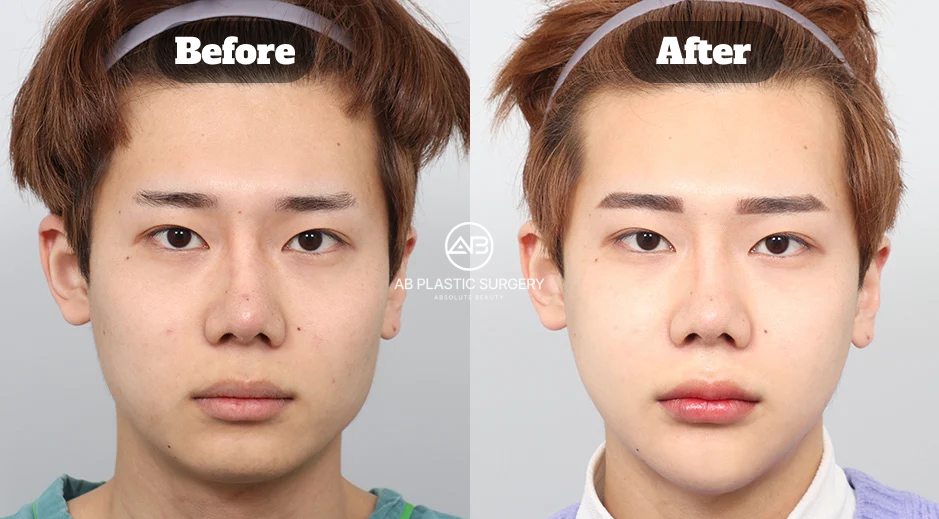 Facial contouring before and after showing square jaw reduction, zygoma reduction, and genioplasty