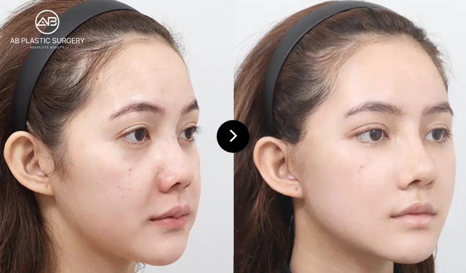 lifting treatment before and after showing changes in facial contour during a Korea beauty treatment plan