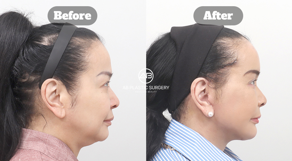 Right-profile photographs labeled Before and After from an AB source identified as full SMAS facelift, neck lift and submental liposuction; the exact postoperative interval is not shown.