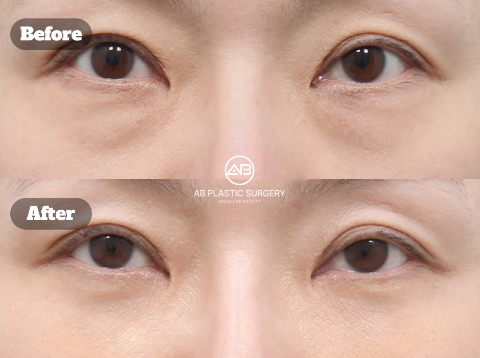 Under eye surgery before and after showing fat repositioning with fat grafting for smoother under eyes