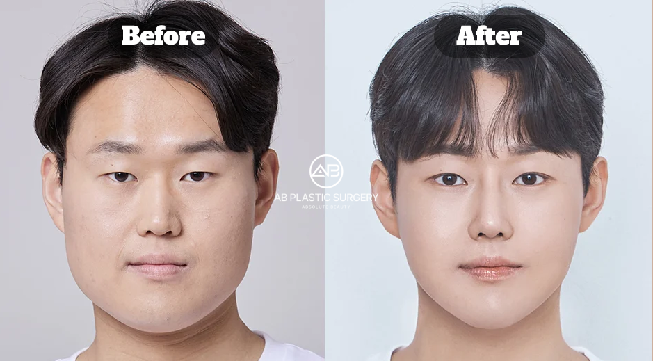 Facial contouring before and after following square jaw reduction, genioplasty, zygoma reduction, masseter reduction, and paranasal implants