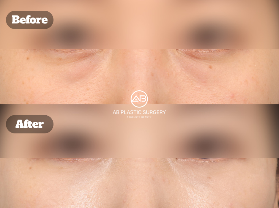Under eye fat repositioning with front cheek fat transfer before and after to improve the under eye and midface contour