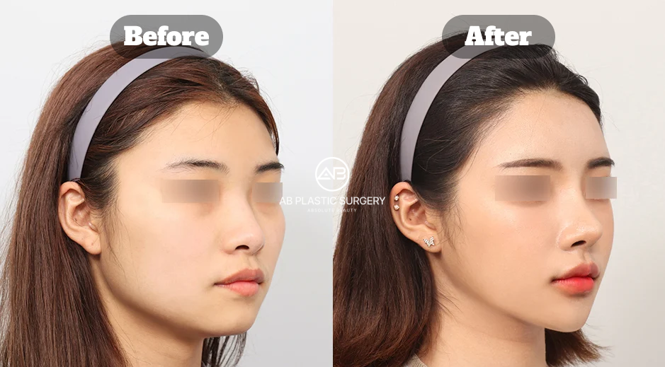Facial contouring before and after combining jaw and zygoma reduction, genioplasty, facial fat grafting, and under eye fat repositioning