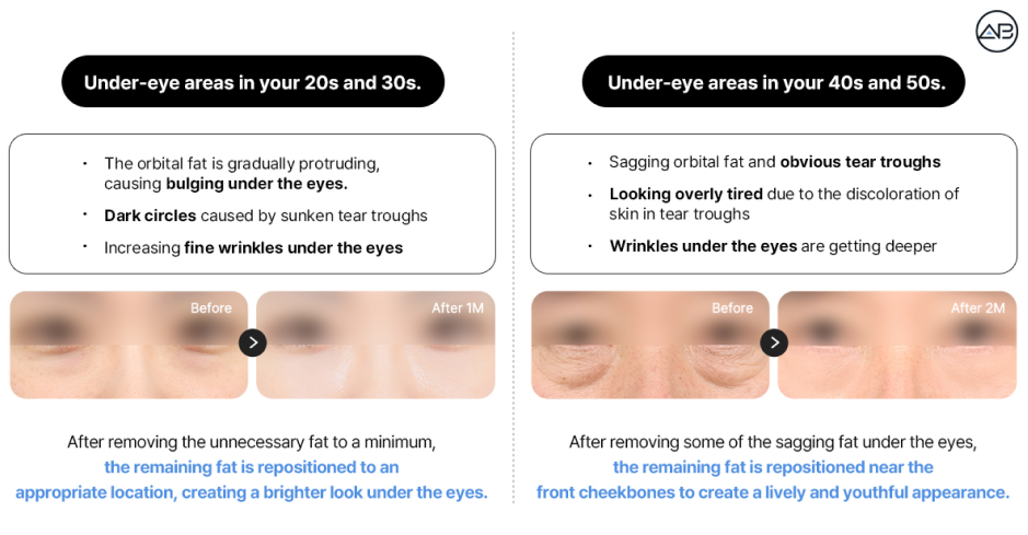 Under eye fat changes by age with tailored fat repositioning for younger and older patients