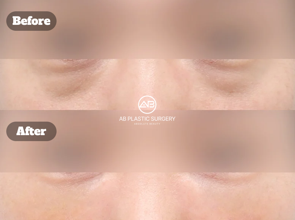 Under eye fat repositioning and front cheek fat grafting before and after for smoother under eye contours