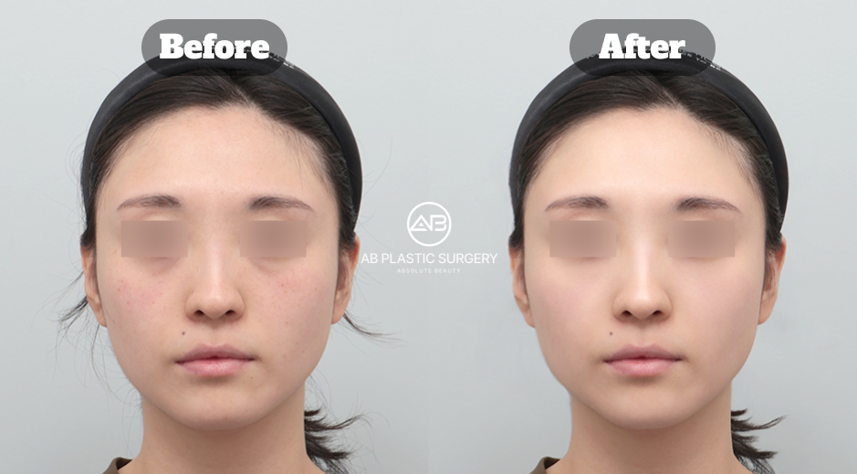 Before and after front-view comparison showing facial redness improvement after aesthetic treatment at AB Plastic Surgery Korea