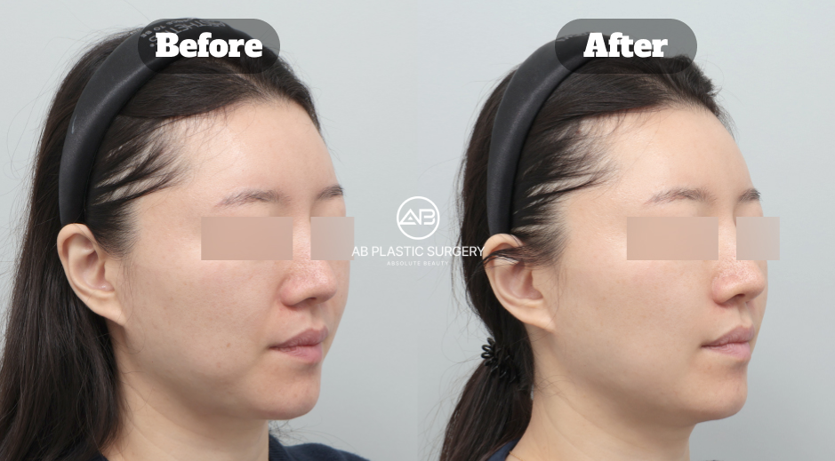 Before and after side-view comparison following facial flushing and melasma treatment at AB Plastic Surgery Korea