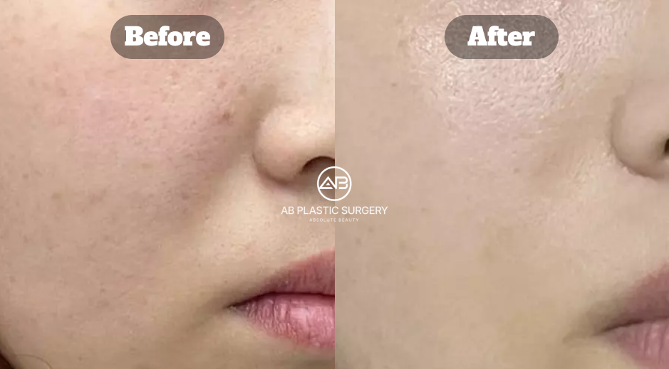 Close-up before and after comparison showing changes in pigmentation and overall skin appearance after Potenza treatment for melasma and skin regeneration