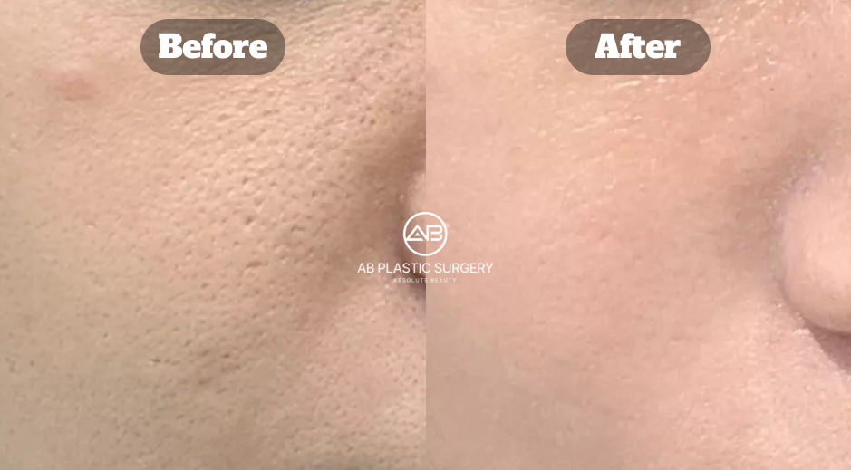 Close-up before and after skin comparison following Potenza treatment for enlarged pores and improved skin elasticity