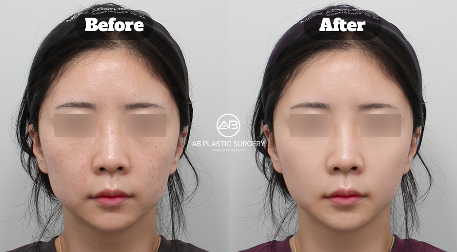 Before and after facial skin comparison following Potenza and Resnovae CRYSTAL treatment for acne scars and uneven skin texture