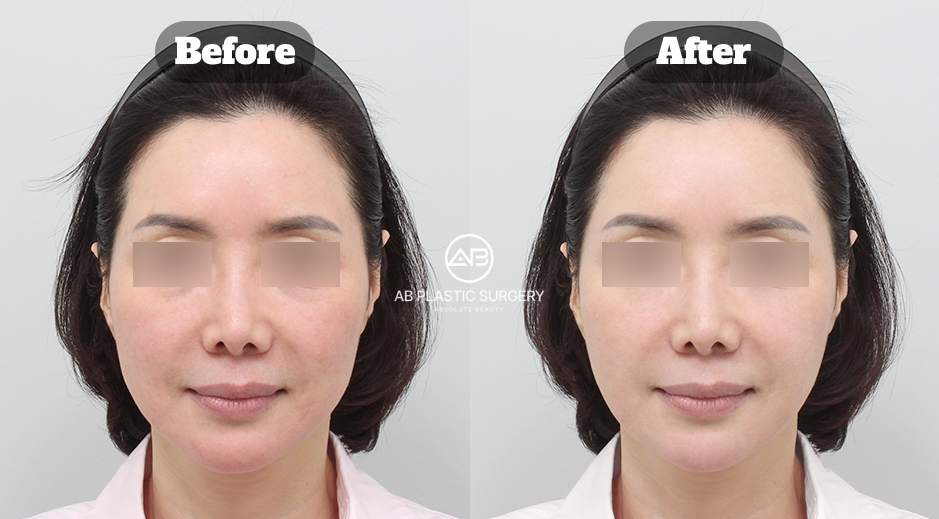 Before and after facial comparison showing reduced visible redness and improved overall skin appearance after Potenza and Resnovae CRYSTAL treatment