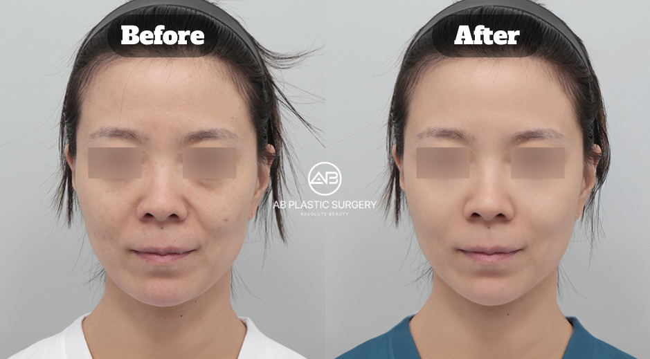 Before and after facial comparison following Potenza treatment targeting pigmentation, melasma appearance, and enlarged pores