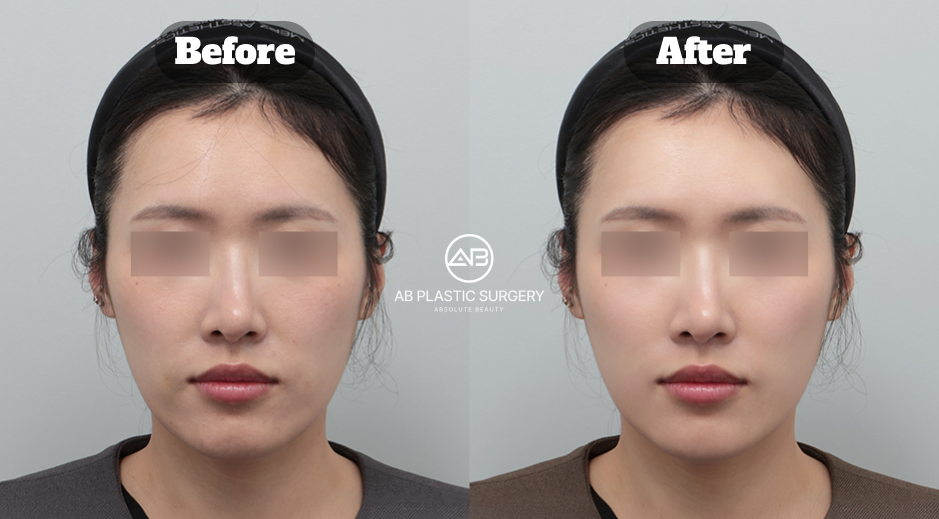 Before and after front-view comparison following rosacea care at AB Plastic Surgery Korea