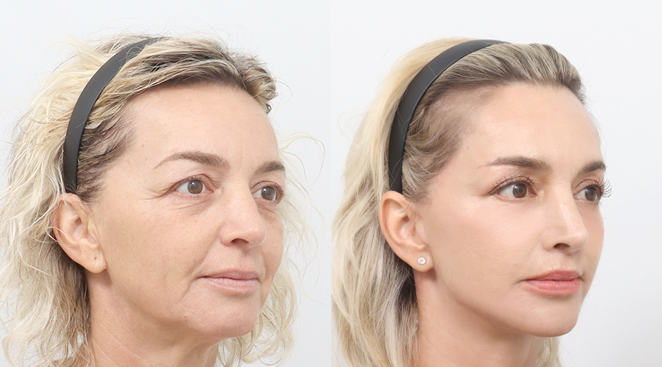 Facelift before and after