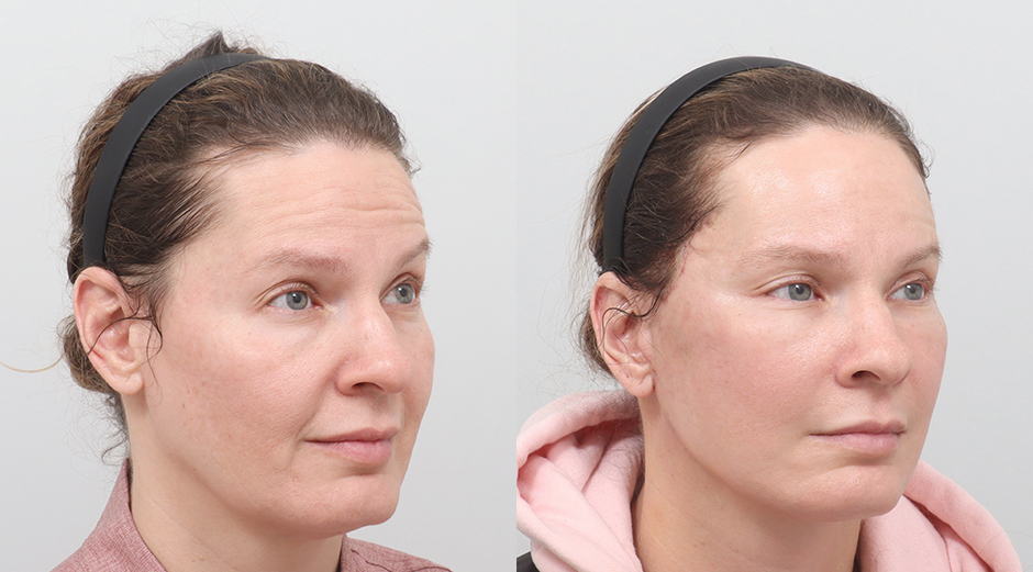 Facelift before and after