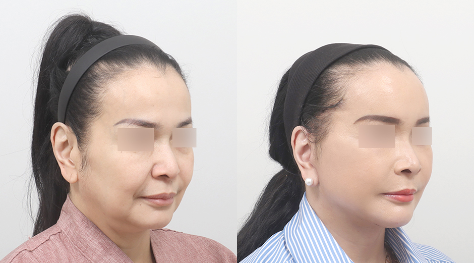 Facelift before and after