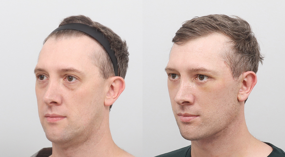 Facelift before and after