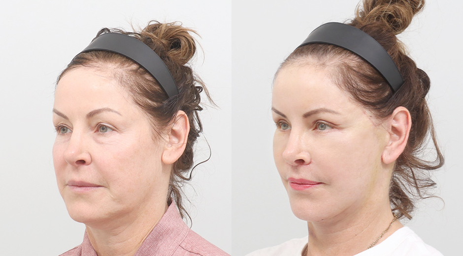 Facelift before and after