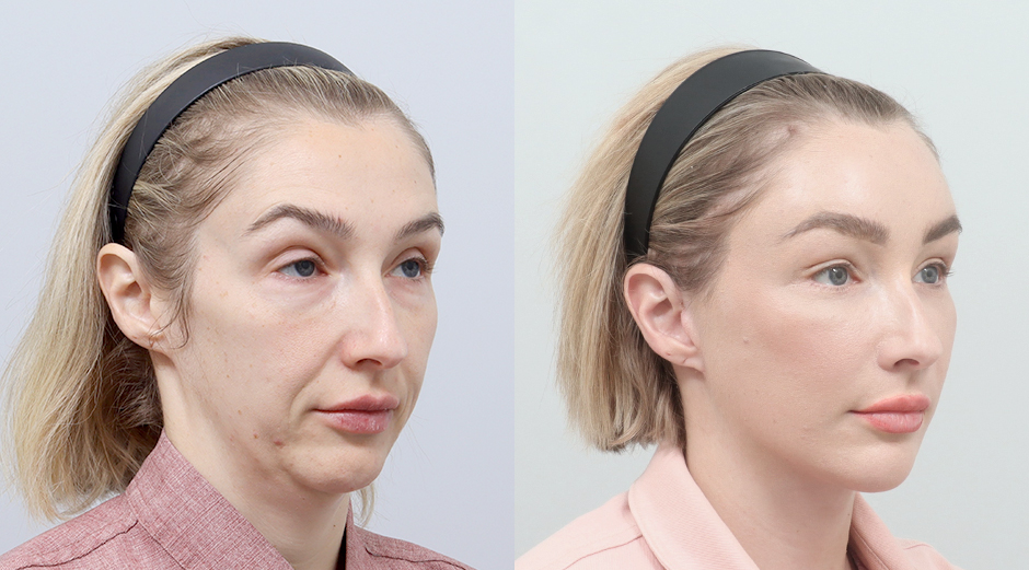 Facelift before and after