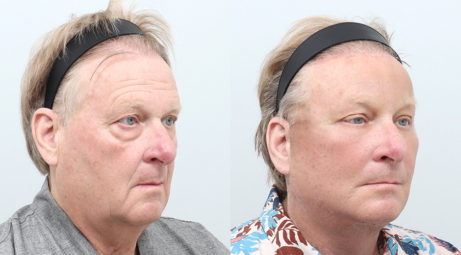 Facelift before and after