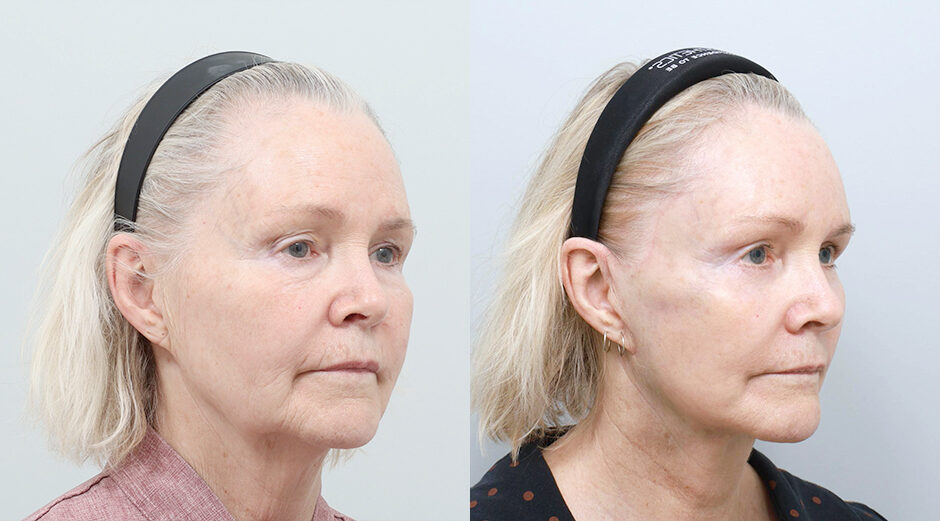 Facelift before and after