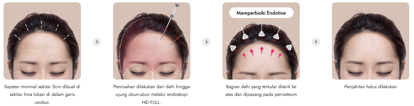 Pengencangan Dahi Implan Endotin