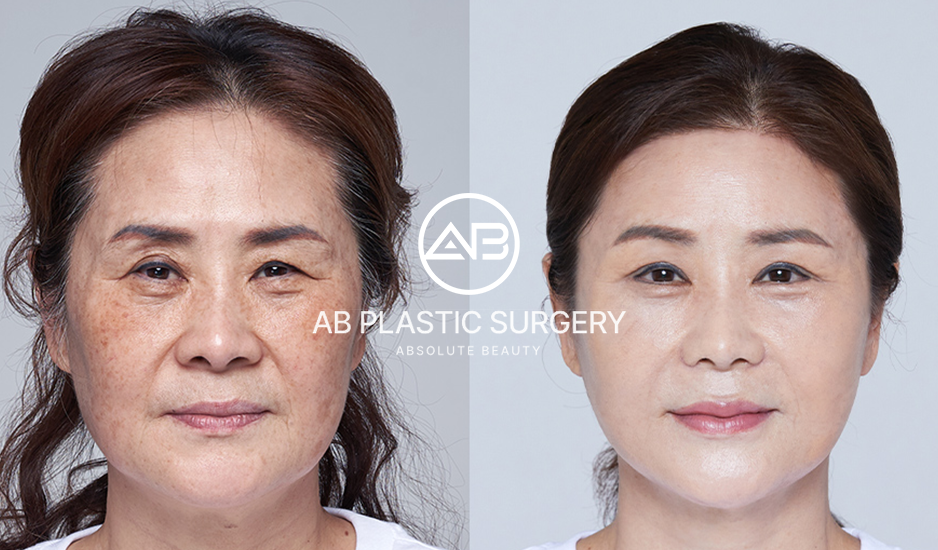 Perbandingan Hasil Sebelum dan Sesudah Perawatan Anti-Aging di Korea