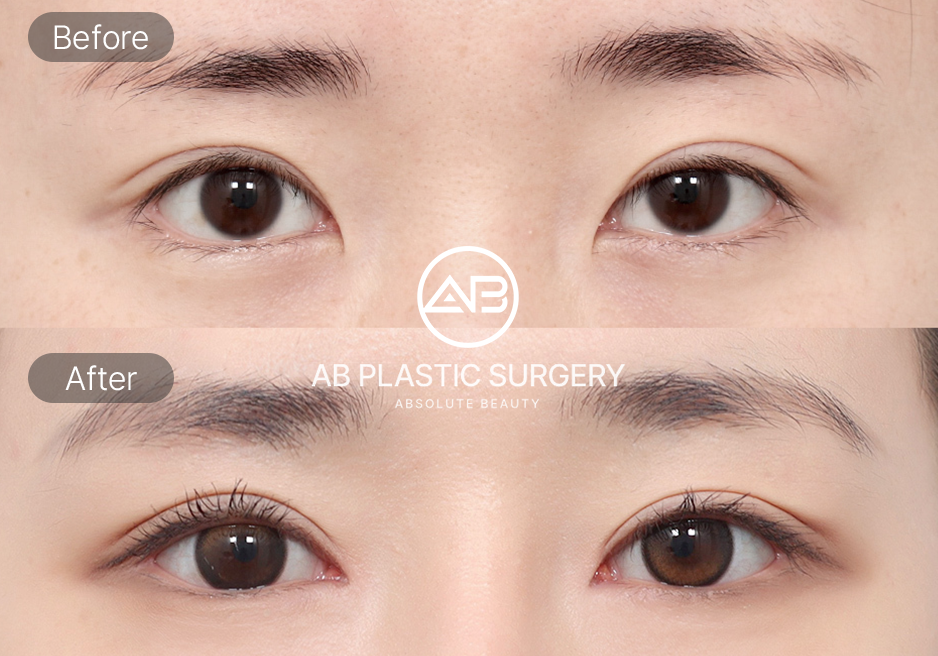 Kisah Sukses Operasi Mata di Korea