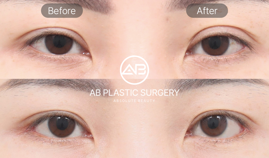 Foto Sebelum dan Sesudah Operasi Kelopak Mata Korea