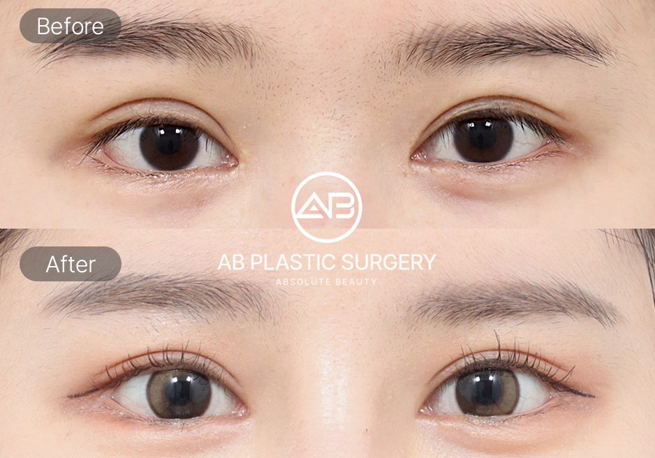 Manfaat Operasi Kelopak Mata Korea