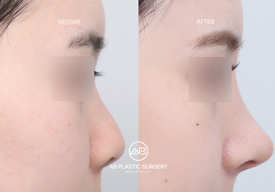 Hasil Operasi Hidung Dolly Korea