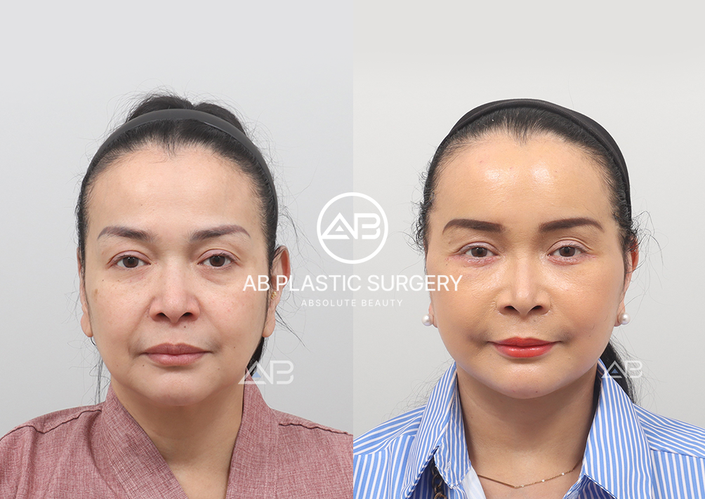 Sebelum Face Lifting VS 1 Minggu Setelah Face Lifting